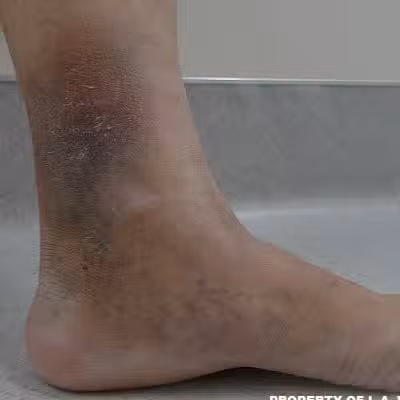 1940-imgset-1-after.jpg LEG ULCER TREATMENT IN LOS ANGELES, CA