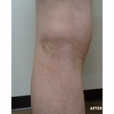 2095-imageset-1-after.jpg SPIDER VEIN TREATMENT IN LOS ANGELES, CA