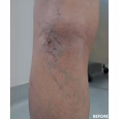 2095-imageset-1-before.jpg SPIDER VEIN TREATMENT IN LOS ANGELES, CA
