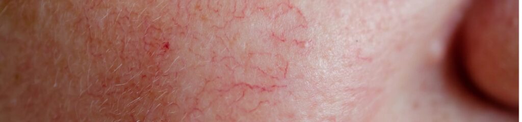 SPIDER VEIN TREATMENT IN LOS ANGELES, CA