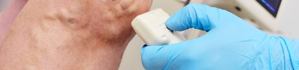 VEIN ULTRASOUND IN LOS ANGELES, CA