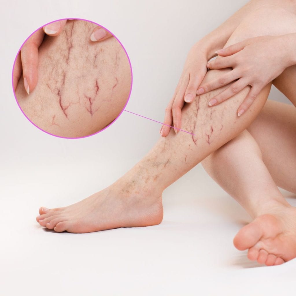 Endovenous Radiofrequency Ablation The Right Vein Treatment For You