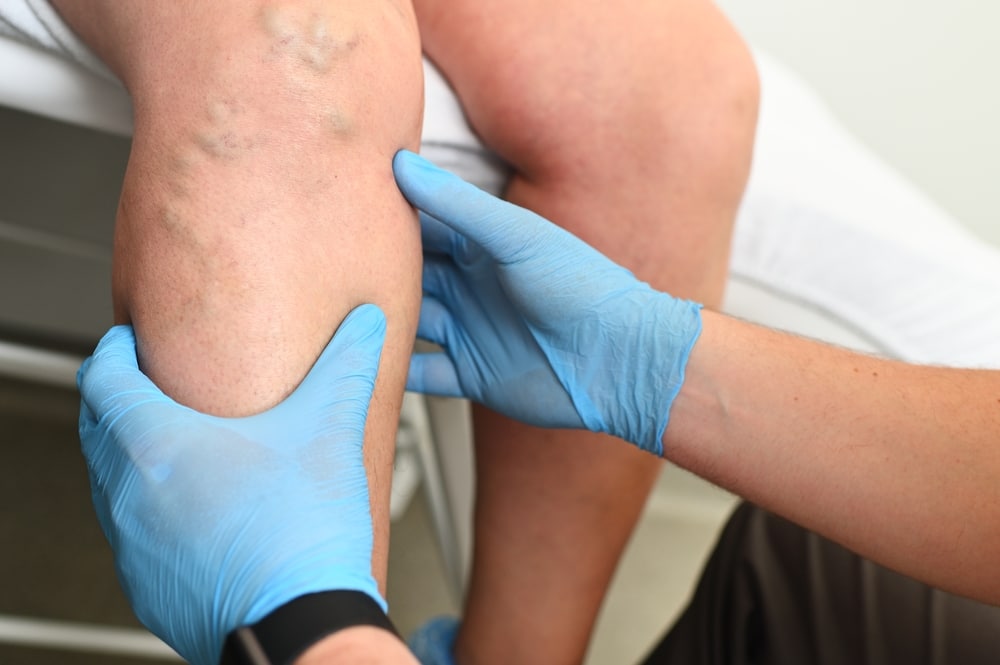 A doctor examining a patient’s varicose veins